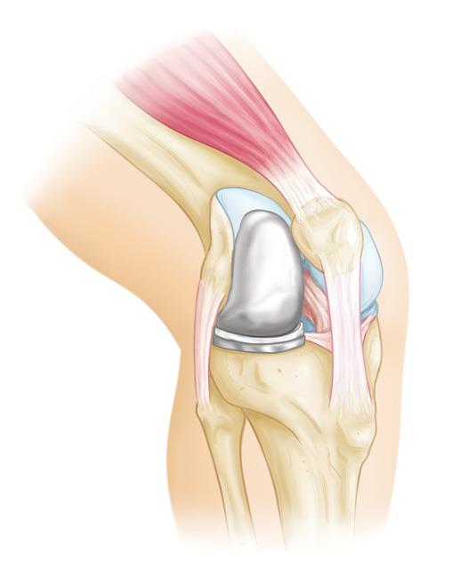 unicompartmental knee replacement